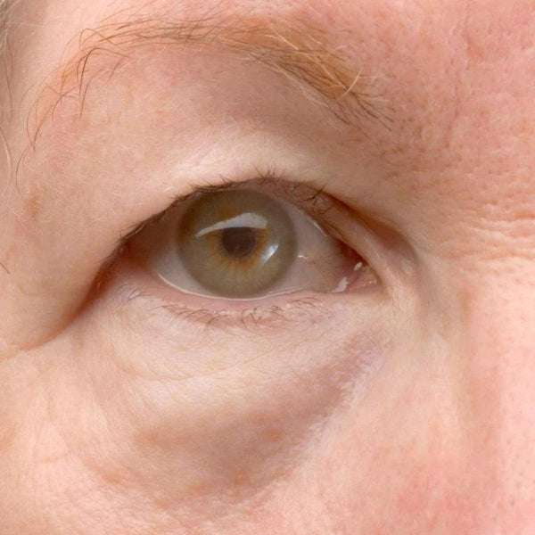 How to Lift Hooded Eyelids Without Surgery