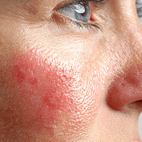 Skin inflammation