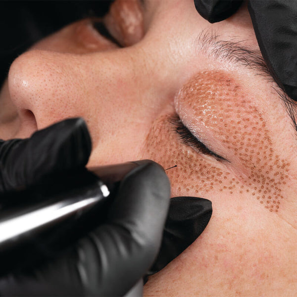 Eyelift Fibroblast Treatment