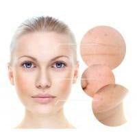 Large Pores on Cheeks - Skin Perfection Natural and Organic Skin Care