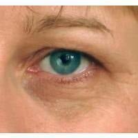 Dark Circles - Skin Perfection Natural and Organic Skin Care