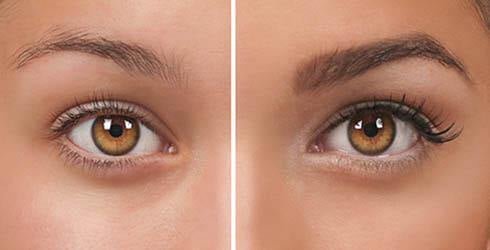 Myristoyl Pentapeptide 17