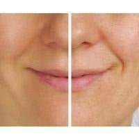 Expression Lines - Skin Perfection Natural and Organic Skin Care